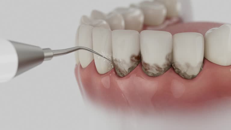 Trusted Dental Crowns And Bridges service in Clifton Forge, VA - Dentist Open Now
